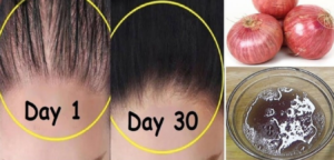 Best Home Remedy for hair loss treatment